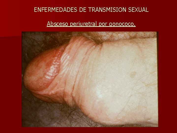 ENFERMEDADES DE TRANSMISION SEXUAL Absceso periuretral por gonococo. 