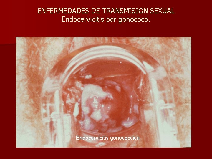 ENFERMEDADES DE TRANSMISION SEXUAL Endocervicitis por gonococo. Endocervicitis gonococcica 