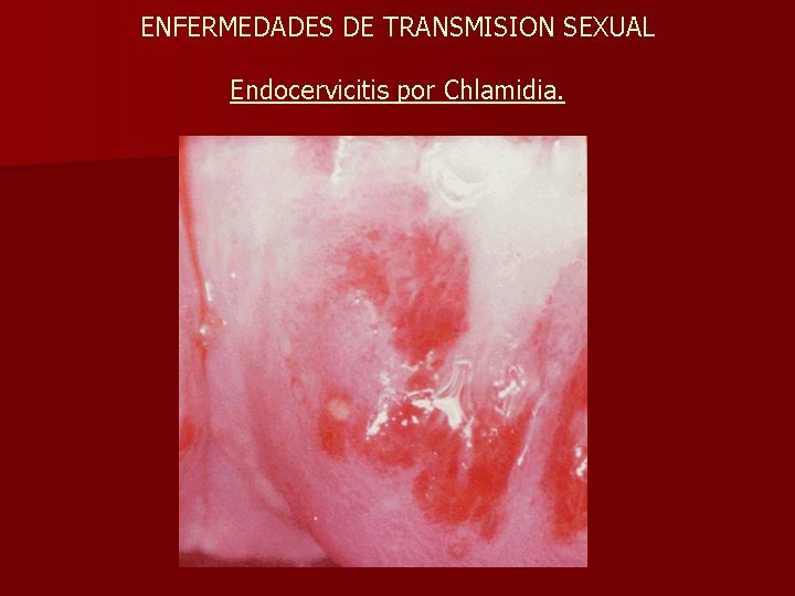 ENFERMEDADES DE TRANSMISION SEXUAL Endocervicitis por Chlamidia. 