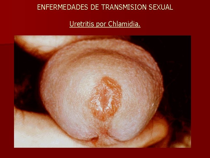 ENFERMEDADES DE TRANSMISION SEXUAL Uretritis por Chlamidia. 
