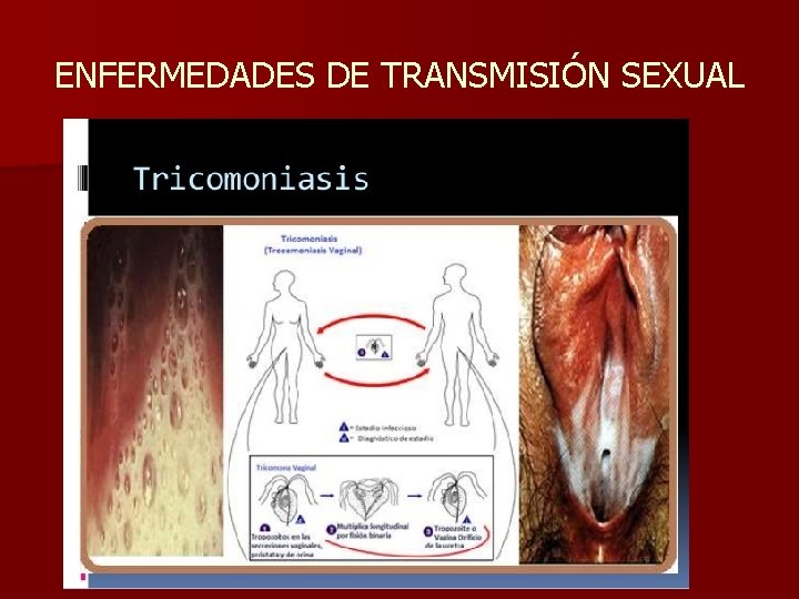 ENFERMEDADES DE TRANSMISIÓN SEXUAL 