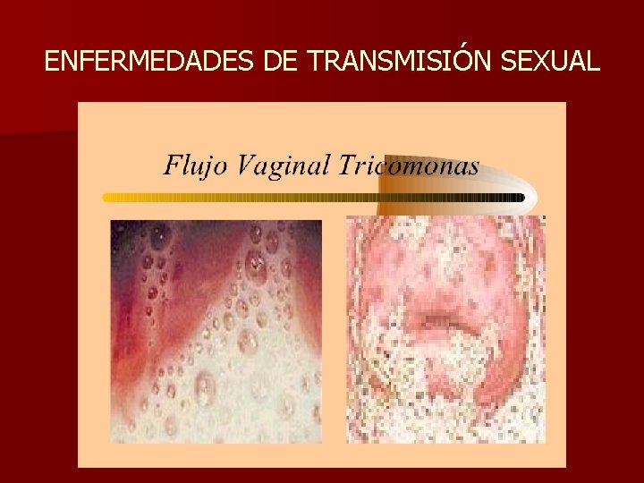 ENFERMEDADES DE TRANSMISIÓN SEXUAL 