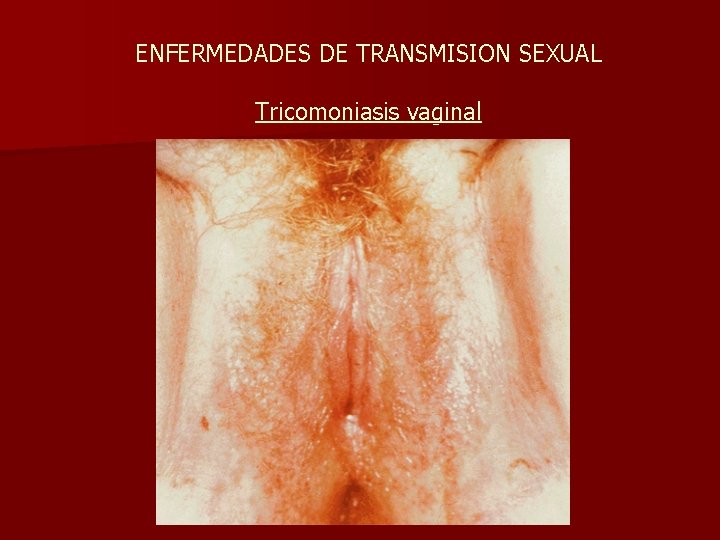 ENFERMEDADES DE TRANSMISION SEXUAL Tricomoniasis vaginal 