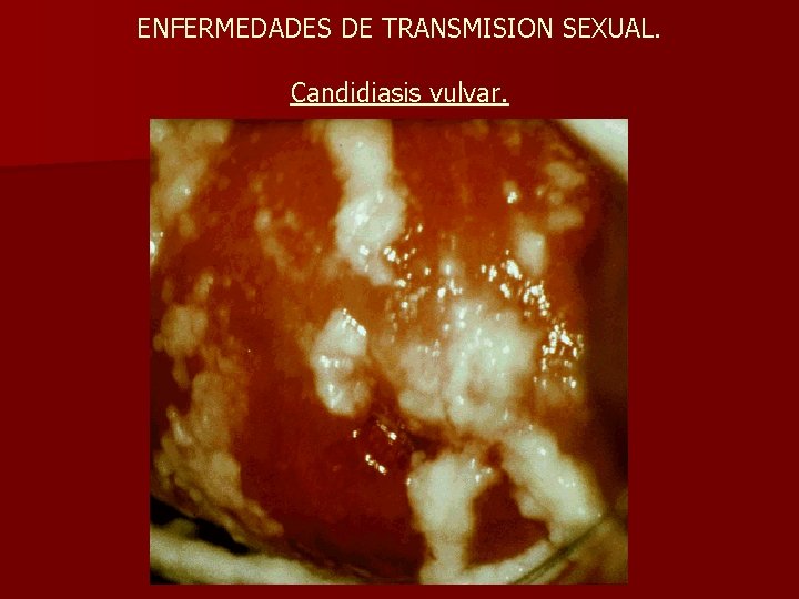 ENFERMEDADES DE TRANSMISION SEXUAL. Candidiasis vulvar. 