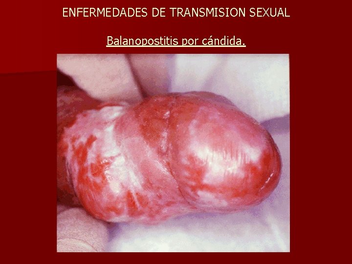 ENFERMEDADES DE TRANSMISION SEXUAL Balanopostitis por cándida. 