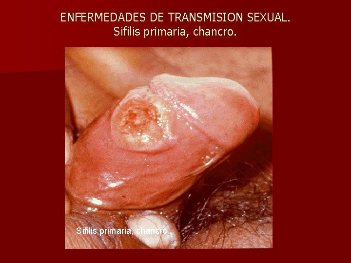 ENFERMEDADES DE TRANSMISION SEXUAL. Sifilis primaria, chancro. Sífilis primaria, chancro 