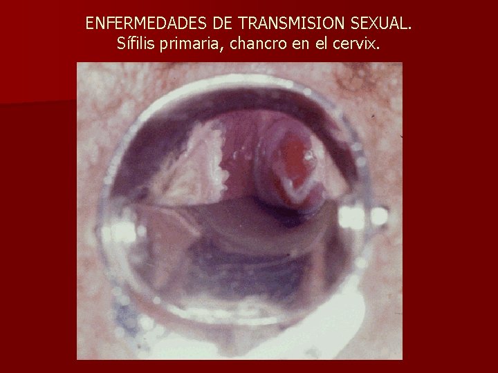 ENFERMEDADES DE TRANSMISION SEXUAL. Sífilis primaria, chancro en el cervix. 
