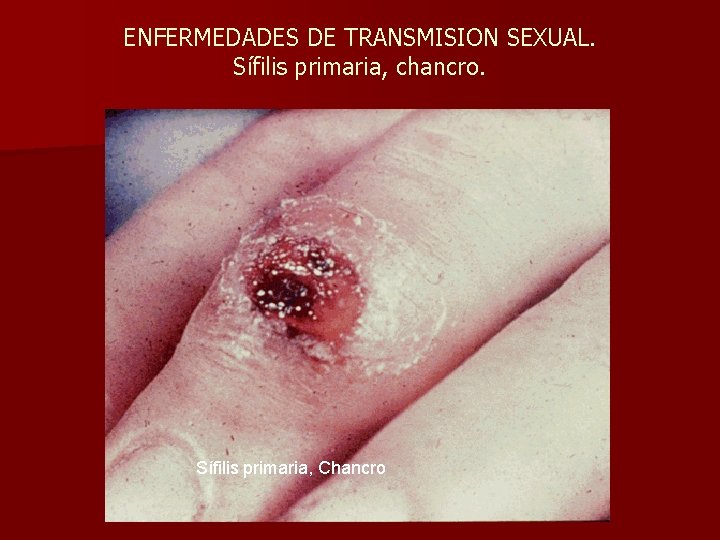 ENFERMEDADES DE TRANSMISION SEXUAL. Sífilis primaria, chancro. Sífilis primaria, Chancro 