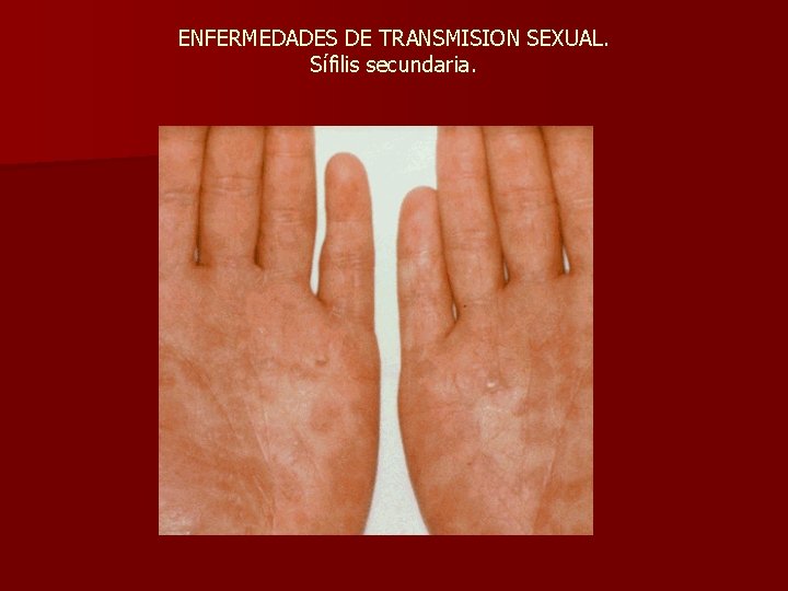 ENFERMEDADES DE TRANSMISION SEXUAL. Sífilis secundaria. 