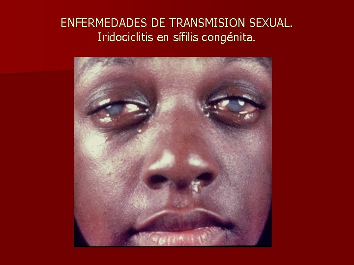 ENFERMEDADES DE TRANSMISION SEXUAL. Iridociclitis en sífilis congénita. 