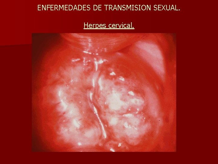 ENFERMEDADES DE TRANSMISION SEXUAL. Herpes cervical. 