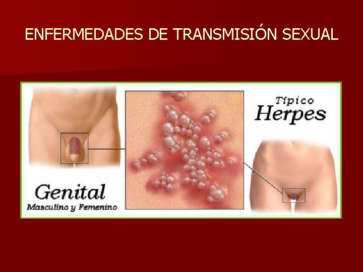 ENFERMEDADES DE TRANSMISIÓN SEXUAL 