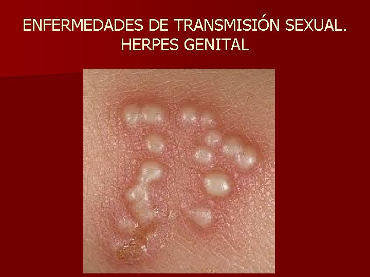 ENFERMEDADES DE TRANSMISIÓN SEXUAL. HERPES GENITAL 