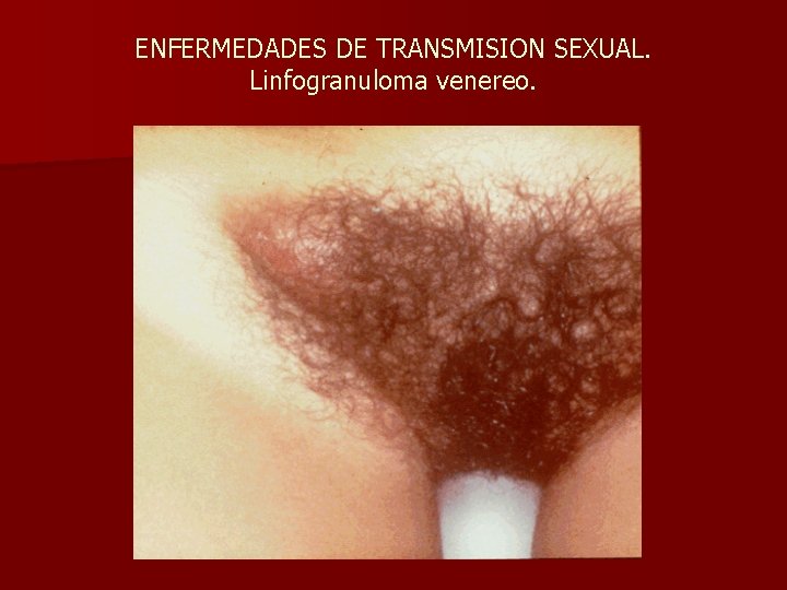 ENFERMEDADES DE TRANSMISION SEXUAL. Linfogranuloma venereo. 