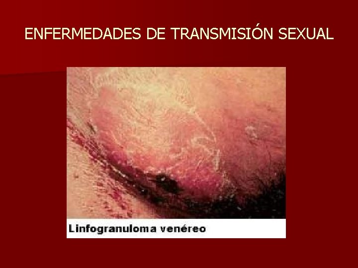 ENFERMEDADES DE TRANSMISIÓN SEXUAL 