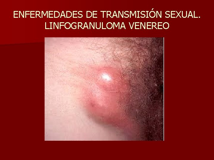 ENFERMEDADES DE TRANSMISIÓN SEXUAL. LINFOGRANULOMA VENEREO 