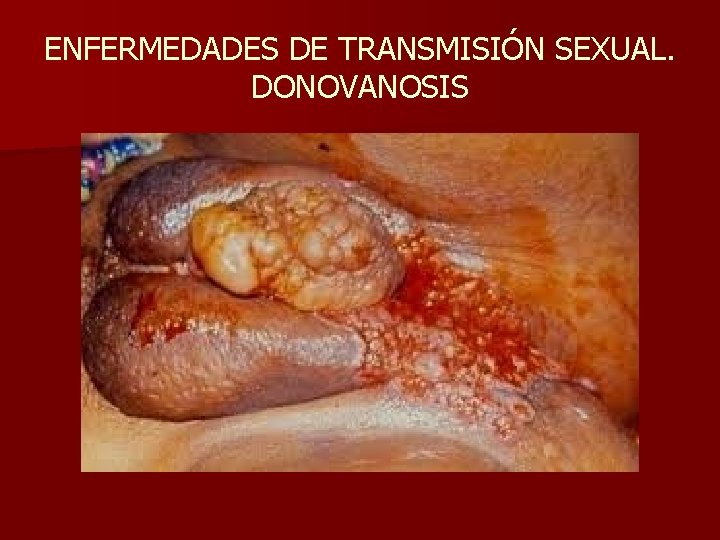 ENFERMEDADES DE TRANSMISIÓN SEXUAL. DONOVANOSIS 