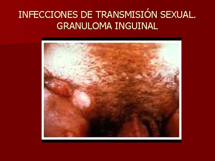 INFECCIONES DE TRANSMISIÓN SEXUAL. GRANULOMA INGUINAL 