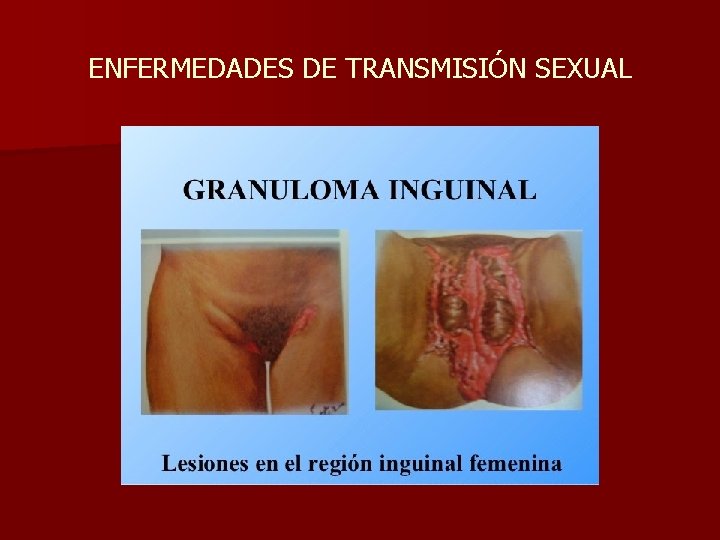 ENFERMEDADES DE TRANSMISIÓN SEXUAL 