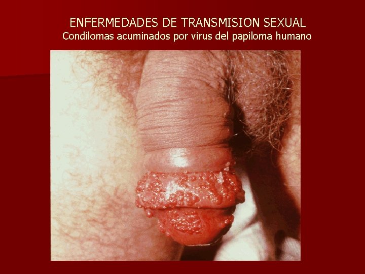 ENFERMEDADES DE TRANSMISION SEXUAL Condilomas acuminados por virus del papiloma humano 
