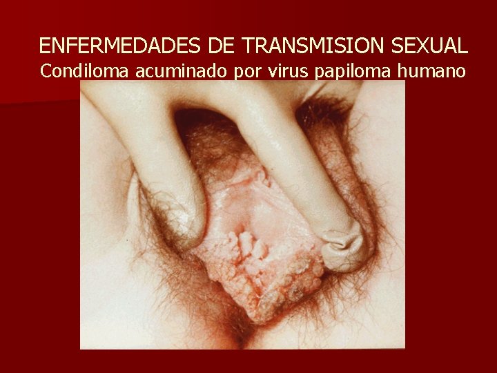 ENFERMEDADES DE TRANSMISION SEXUAL Condiloma acuminado por virus papiloma humano 