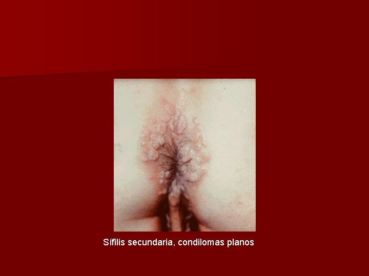 Sífilis secundaria, condilomas planos 