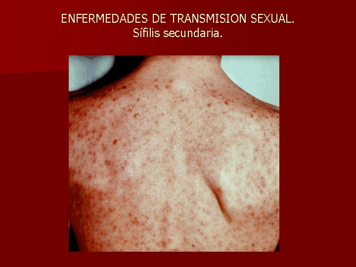 ENFERMEDADES DE TRANSMISION SEXUAL. Sífilis secundaria. 