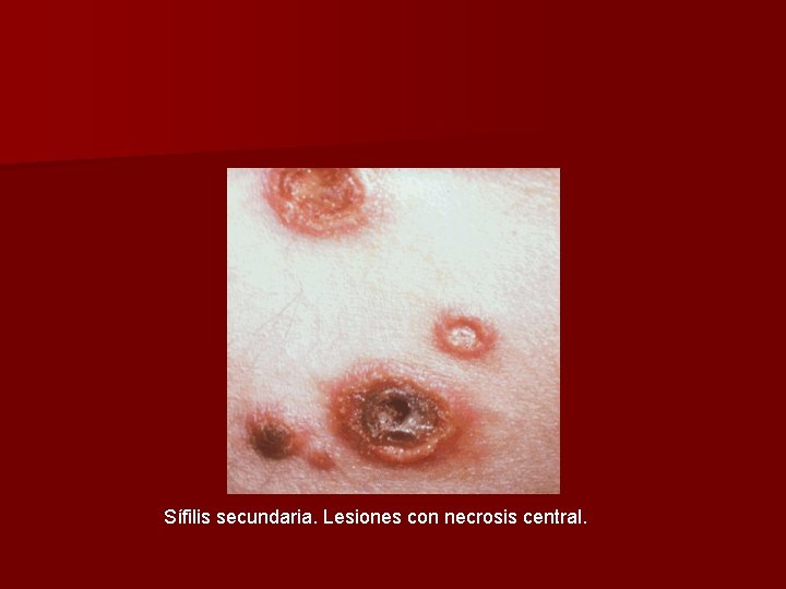 Sífilis secundaria. Lesiones con necrosis central. 