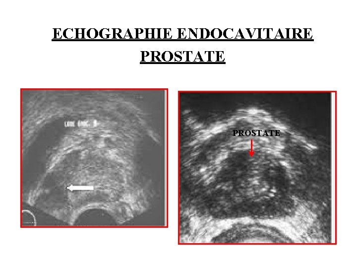 ECHOGRAPHIE ENDOCAVITAIRE PROSTATE 