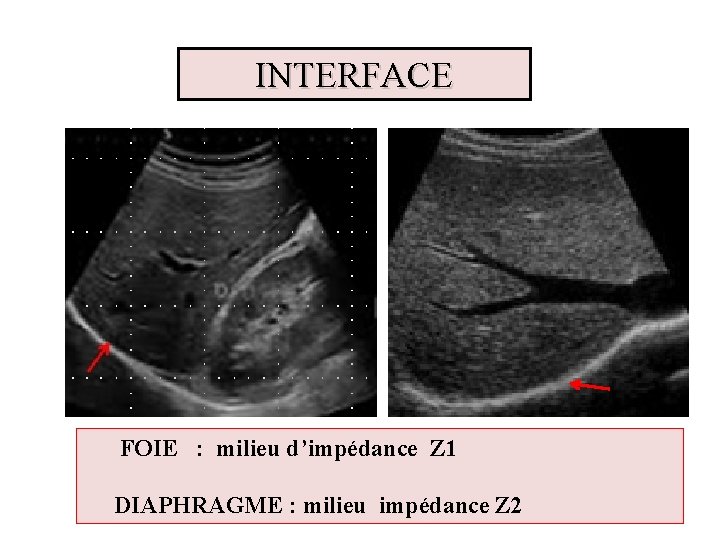 INTERFACE FOIE : milieu d’impédance Z 1 DIAPHRAGME : milieu impédance Z 2 