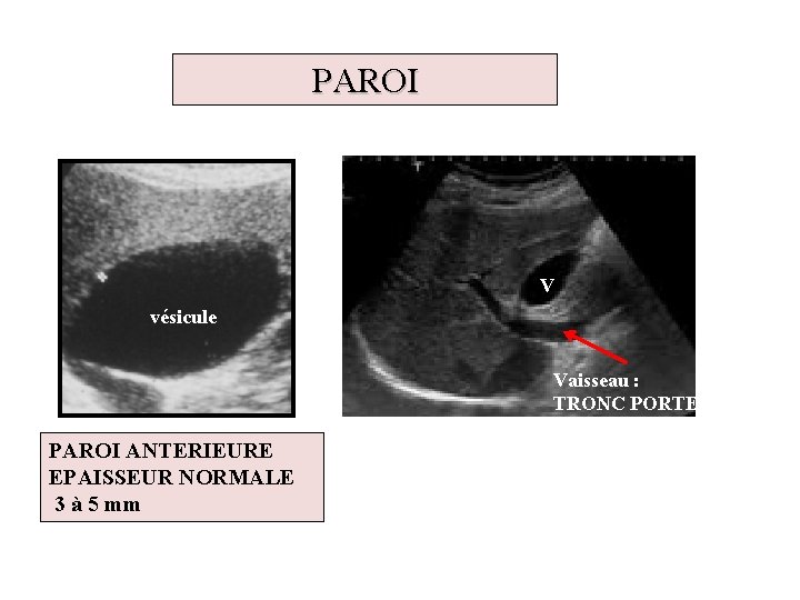 PAROI V vésicule Vaisseau : TRONC PORTE PAROI ANTERIEURE EPAISSEUR NORMALE 3 à 5