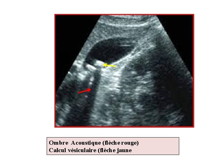 Ombre Acoustique (flèche rouge) Calcul vésiculaire (flèche jaune 