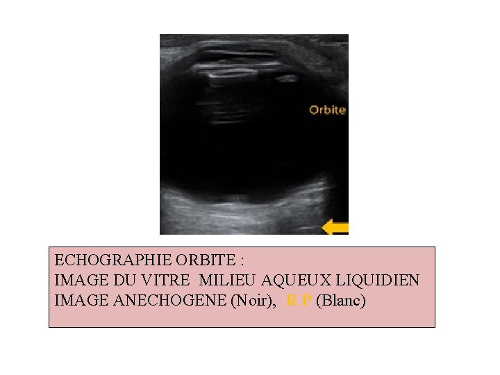 ECHOGRAPHIE ORBITE : IMAGE DU VITRE MILIEU AQUEUX LIQUIDIEN IMAGE ANECHOGENE (Noir), R P