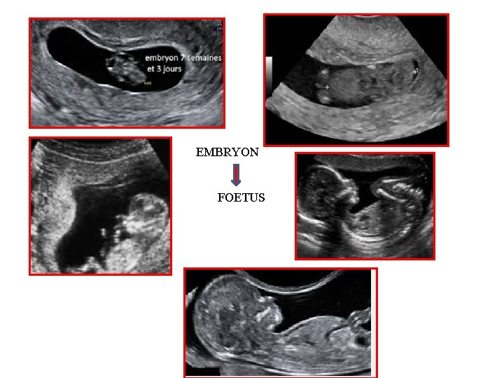 EMBRYON FOETUS 