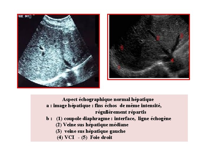 Aspect échographique normal hépatique a : image hépatique : fins échos de même intensité,