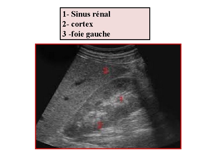 1 - Sinus rénal 2 - cortex 3 -foie gauche 