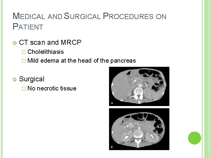 MEDICAL AND SURGICAL PROCEDURES ON PATIENT CT scan and MRCP � Cholelithiasis � Mild MEDICAL AND SURGICAL PROCEDURES ON PATIENT CT scan and MRCP � Cholelithiasis � Mild