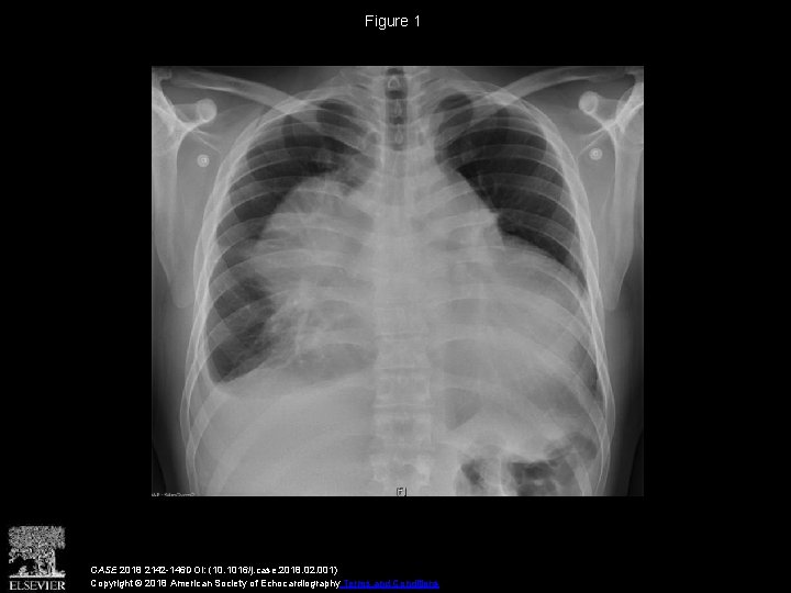 Figure 1 CASE 2018 2142 -146 DOI: (10. 1016/j. case. 2018. 02. 001) Copyright