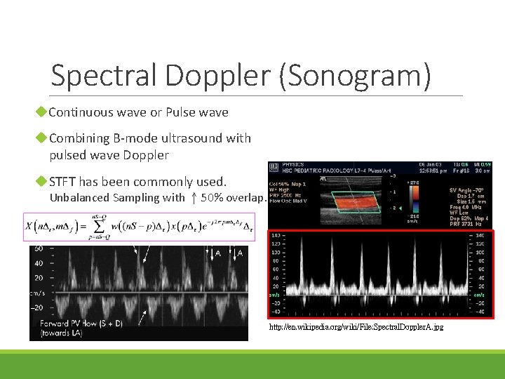 Spectral Doppler (Sonogram) u. Continuous wave or Pulse wave u. Combining B-mode ultrasound with