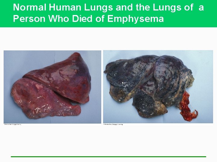 Normal Human Lungs and the Lungs of a Person Who Died of Emphysema 