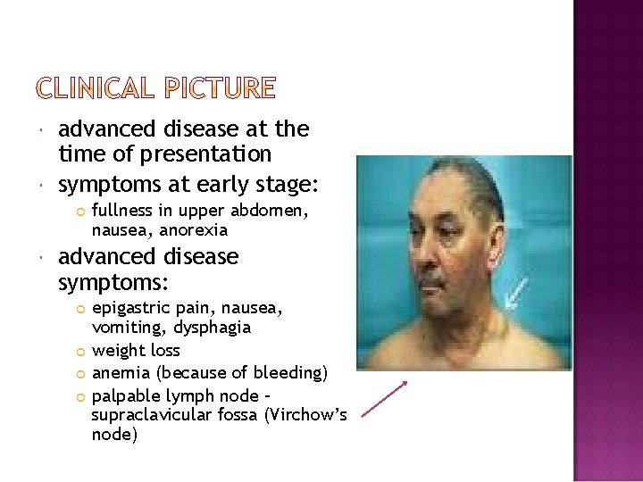  advanced disease at the time of presentation symptoms at early stage: fullness in