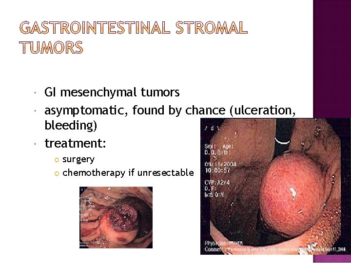  GI mesenchymal tumors asymptomatic, found by chance (ulceration, bleeding) treatment: surgery chemotherapy if