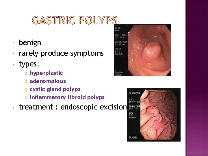  benign rarely produce symptoms types: hyperplastic adenomatous cystic gland polyps inflammatory fibroid polyps