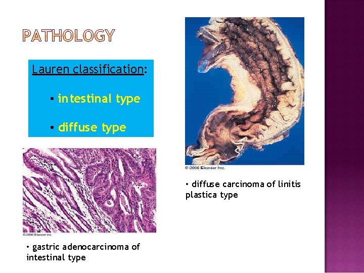 Lauren classification: • intestinal type • diffuse type • diffuse carcinoma of linitis plastica