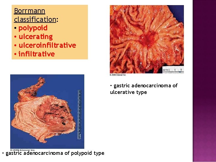 Borrmann classification: • polypoid • ulcerating • ulceroinfiltrative • infiltrative • gastric adenocarcinoma of