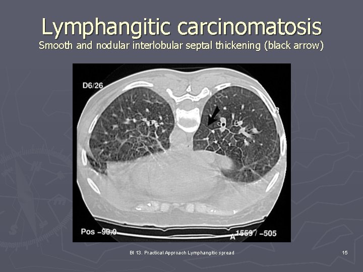 can thyroid problems cause cardiovascular diseases