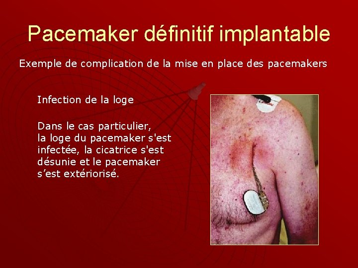 Pacemaker définitif implantable Exemple de complication de la mise en place des pacemakers Infection