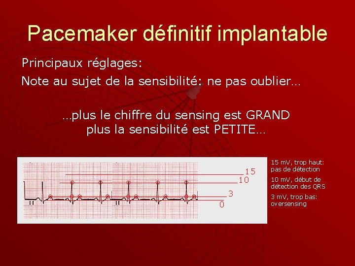 Pacemaker définitif implantable Principaux réglages: Note au sujet de la sensibilité: ne pas oublier…