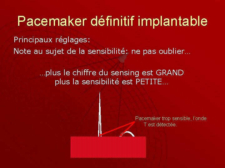 Pacemaker définitif implantable Principaux réglages: Note au sujet de la sensibilité: ne pas oublier…