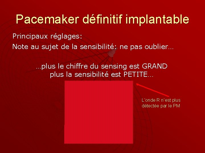 Pacemaker définitif implantable Principaux réglages: Note au sujet de la sensibilité: ne pas oublier…